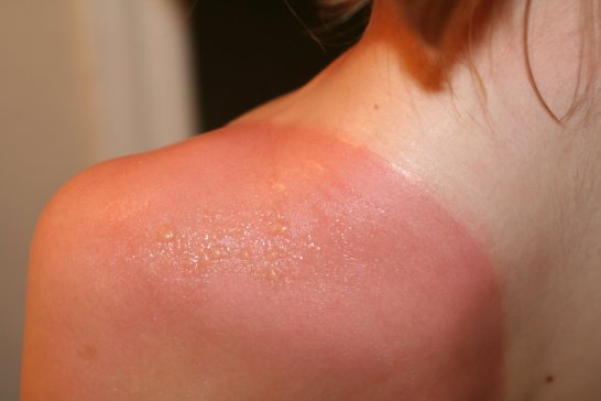 how-to-get-rid-of-sunburns